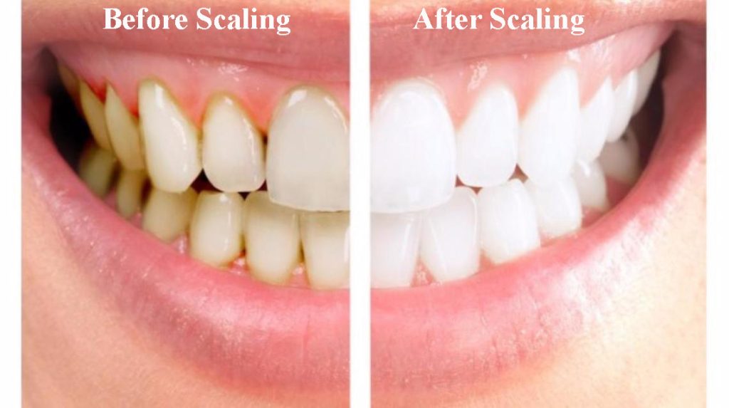 Best Dental Scaling at a very low cost 