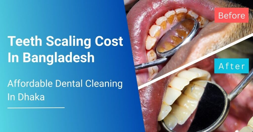 Dental Scaling in Mirpur 4 image 1