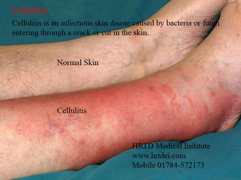 Cellulitis and Normal Skin