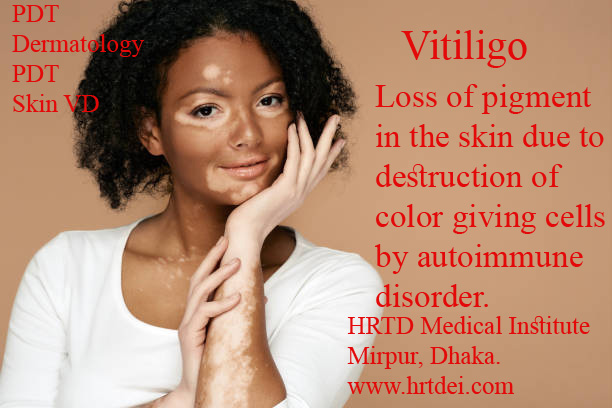 Vitiligo Definition, Image and Treatment 