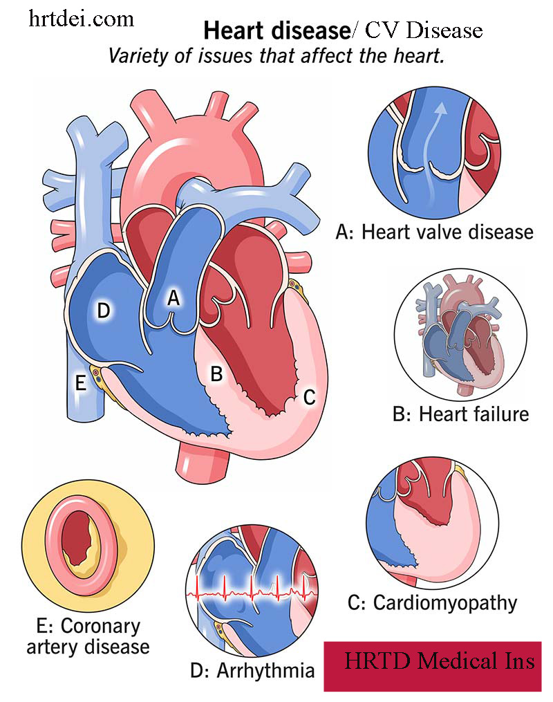 Cardiovascular Diseases Image