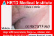 Fungal Infections(Tineasis & Candidiasis)