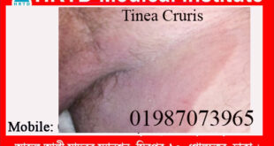 Fungal Infections(Tineasis & Candidiasis)