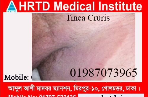 Fungal Infections(Tineasis & Candidiasis)