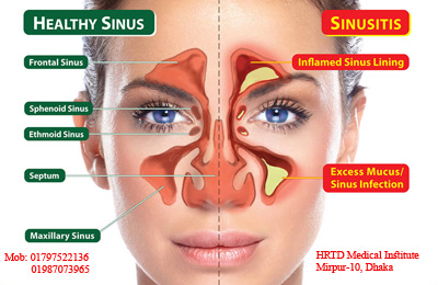 Rhinology/ নাকের রোগ বিদ্যা 3 Sinusitis