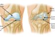 Arthritis & Osteoporosis ( Geriatric Disease)
