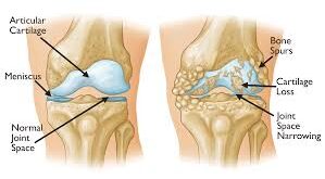 Arthritis & Osteoporosis ( Geriatric Disease)