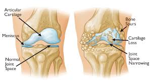 Arthritis Osteoporosis