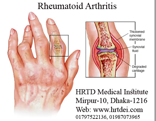 Rheumatoid Arthritis