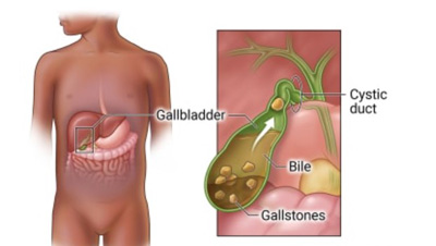 Abdominal Pain Due To Cholecystitis