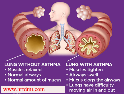 Asthma