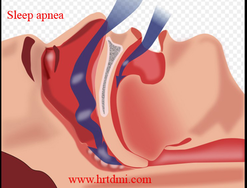 Sleep apnea 1 Sleep apnea image