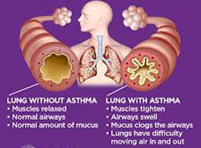 Asthma Management and Treatment 