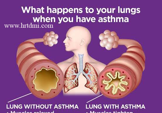 Respiratory Disease and Homeopathic Treatment 2 Asthma