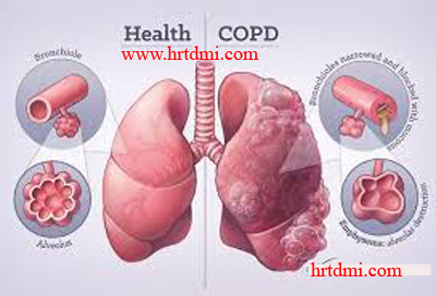 Respiratory Disease and Homeopathic Treatment 3 COPD or, Chronic Obstructive Pulmonary Disease