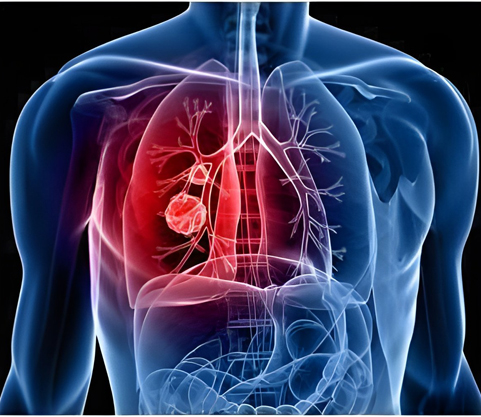 Respiratory Disease and Homeopathic Treatment 1 Respiratory Disease